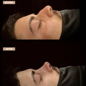 Revision Rhinoplasty Before & After