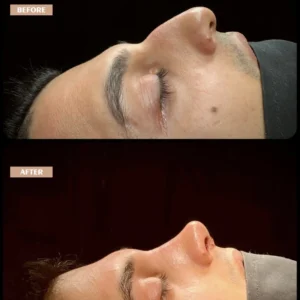 Revision Rhinoplasty Before & After