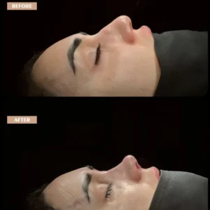 Revision Rhinoplasty Before & After
