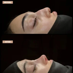 Revision Rhinoplasty Before & After