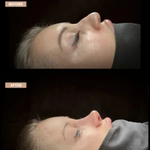 Revision Rhinoplasty Before & After