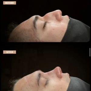 Revision Rhinoplasty Before & After