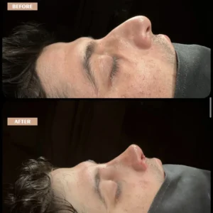 Revision Rhinoplasty Before & After