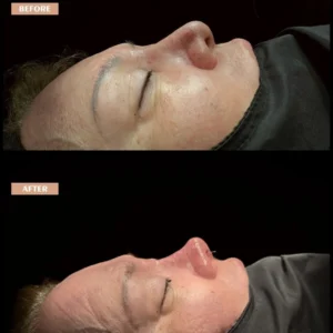 Revision Rhinoplasty Before & After
