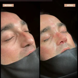 Revision Rhinoplasty Before & After