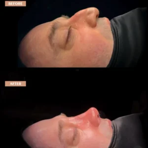 Revision Rhinoplasty Before & After