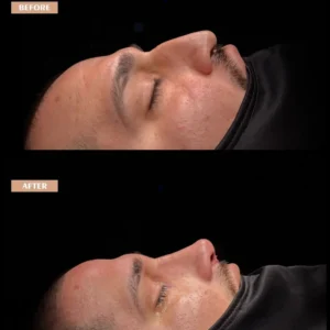 Revision Rhinoplasty Before & After