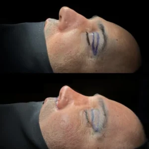 Revision Rhinoplasty Before & After
