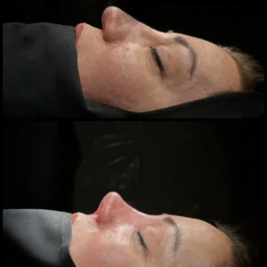 Revision Rhinoplasty Before & After