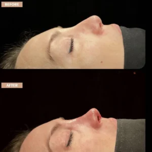 Revision Rhinoplasty Before & After