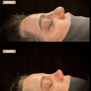 Revision Rhinoplasty Before & After