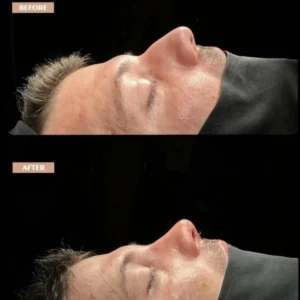 Revision Rhinoplasty Before & After
