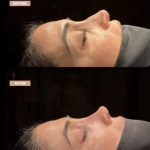 Revision Rhinoplasty Before & After