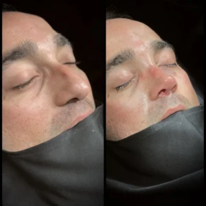 Revision Rhinoplasty Before & After