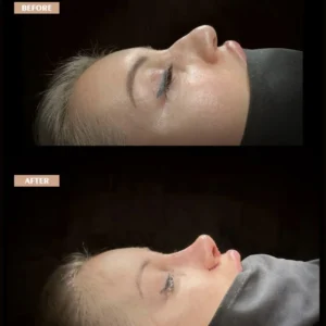 Revision Rhinoplasty Before & After