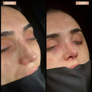 Revision Rhinoplasty Before & After