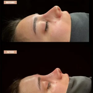 Revision Rhinoplasty Before & After