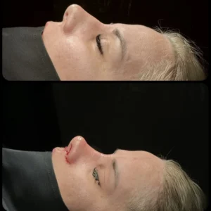 Revision Rhinoplasty Before & After
