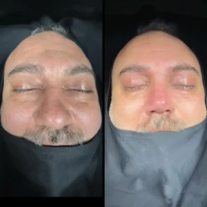 Revision Rhinoplasty Before & After