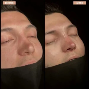 Revision Rhinoplasty Before & After