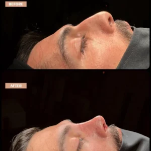 Revision Rhinoplasty Before & After