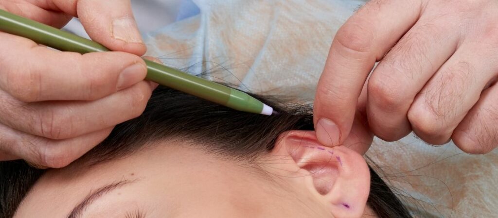 Revizyon Kepçe Kulak Ameliyatı Revizyon Kepçe Kulak Ameliyatı