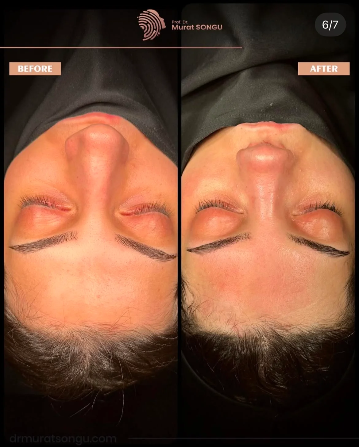 Chirurgie du Nez Dévié Avant & Après