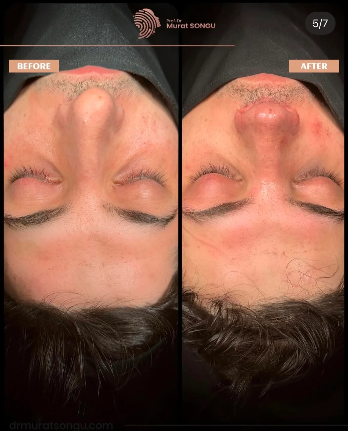 Chirurgie du Nez Dévié Avant & Après