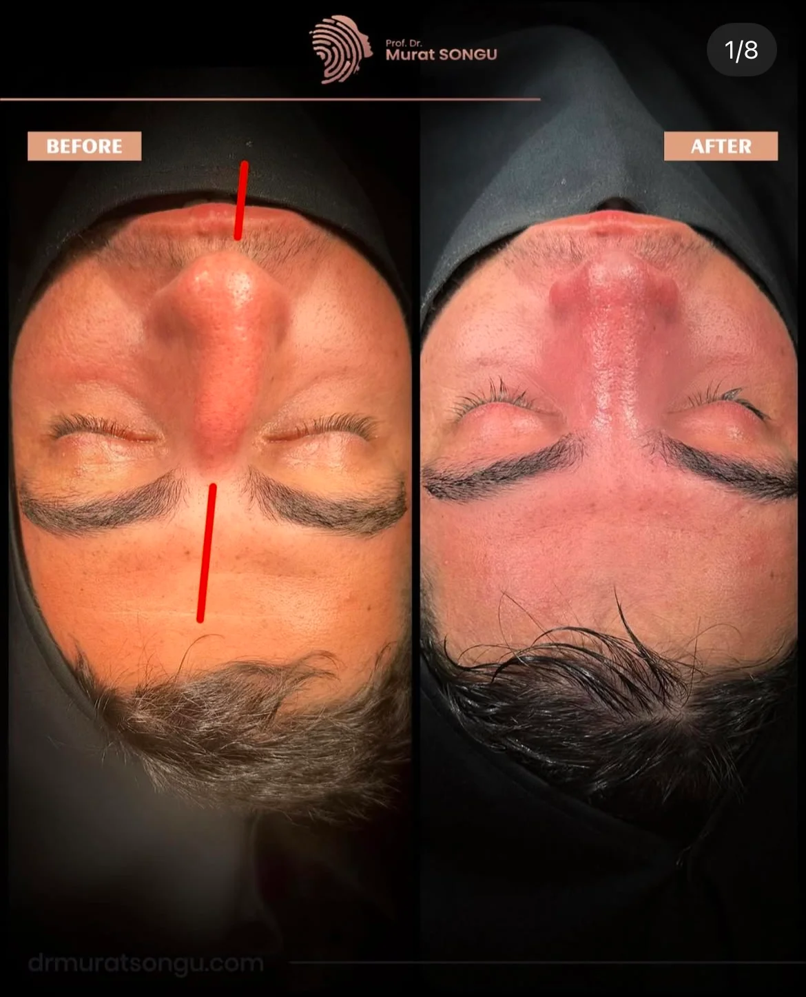 Chirurgie du Nez Dévié Avant & Après