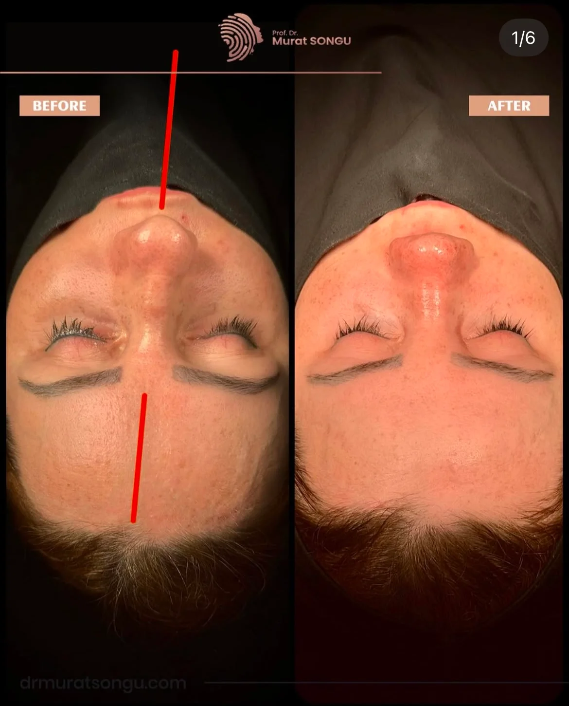 Chirurgie du Nez Dévié Avant & Après