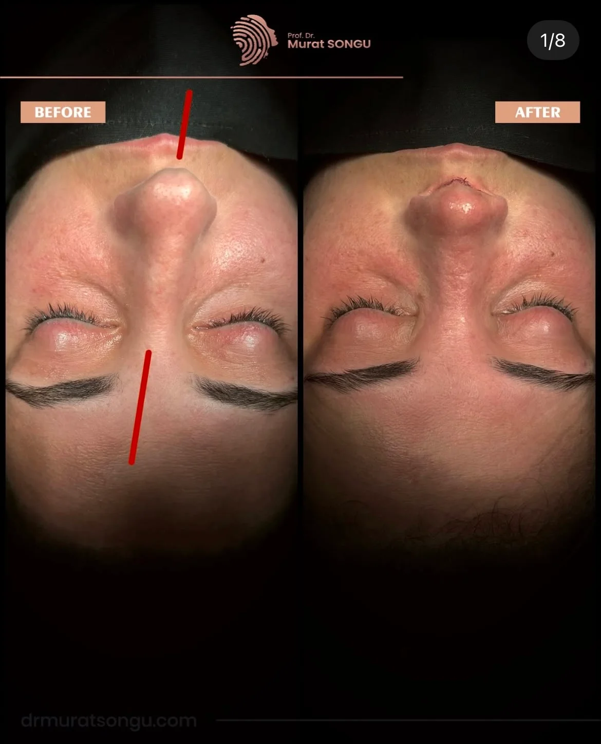 Chirurgie du Nez Dévié Avant & Après