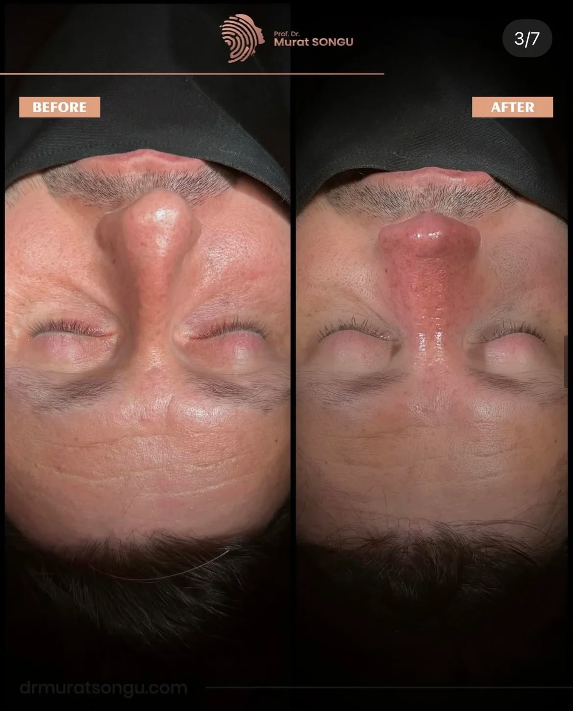 Chirurgie du Nez Dévié Avant & Après