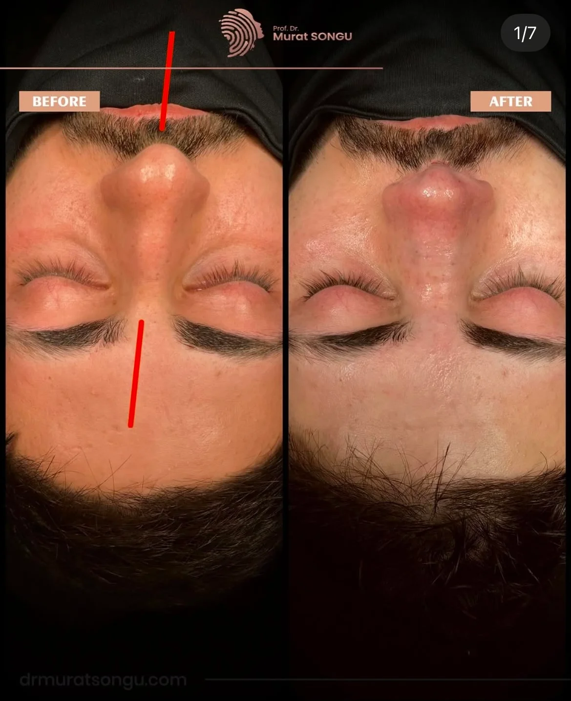 Chirurgie du Nez Dévié Avant & Après