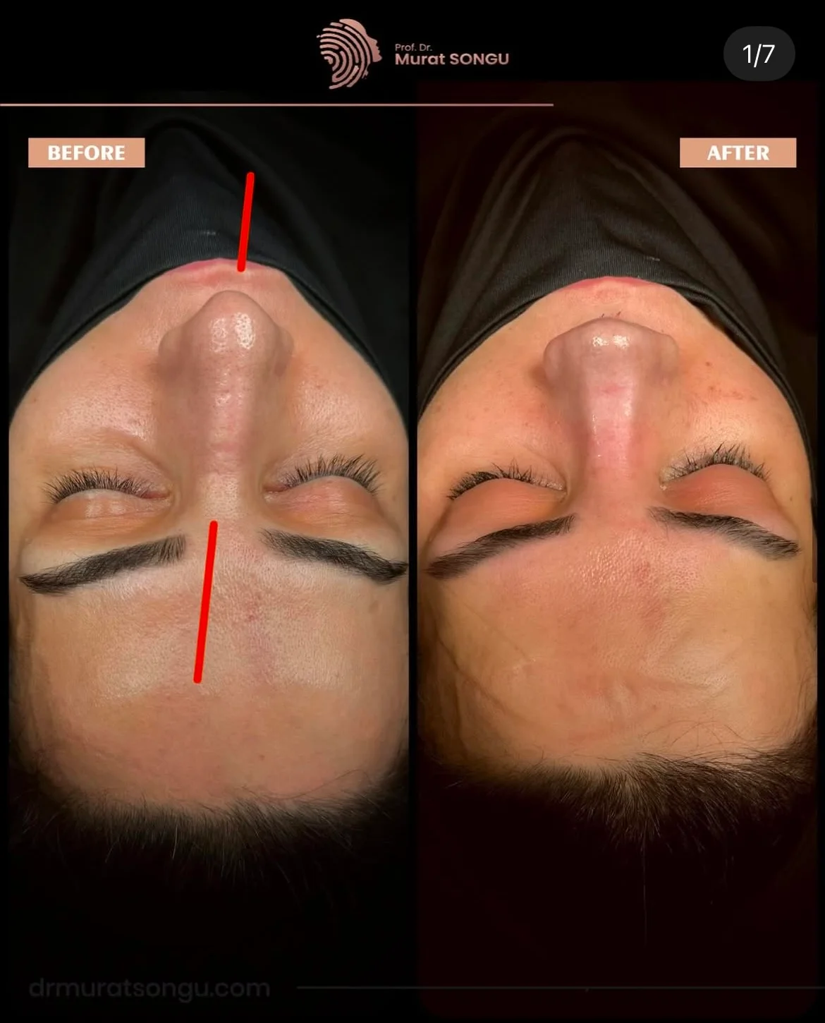 Chirurgie du Nez Dévié Avant & Après