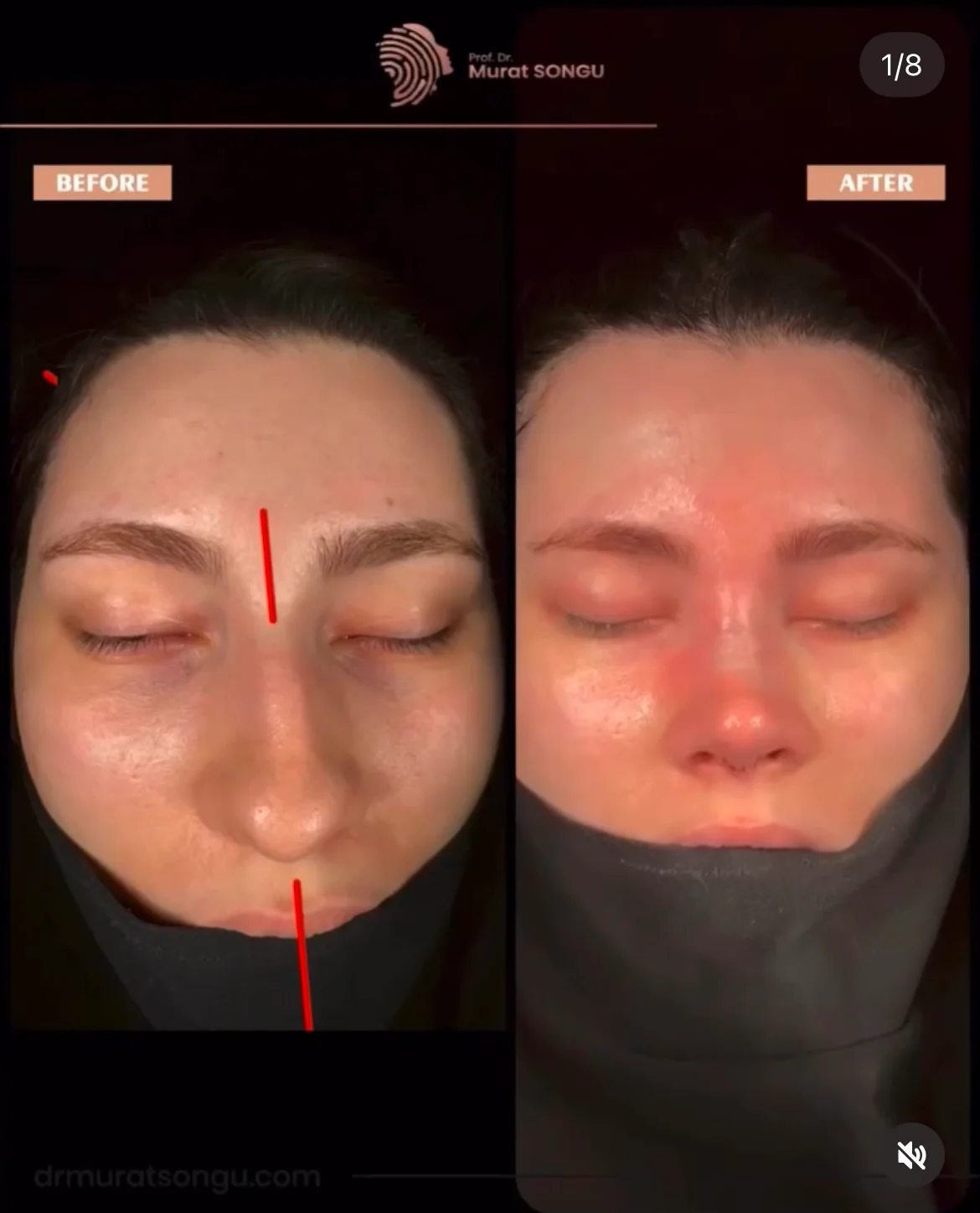 Chirurgie du Nez Dévié Avant & Après