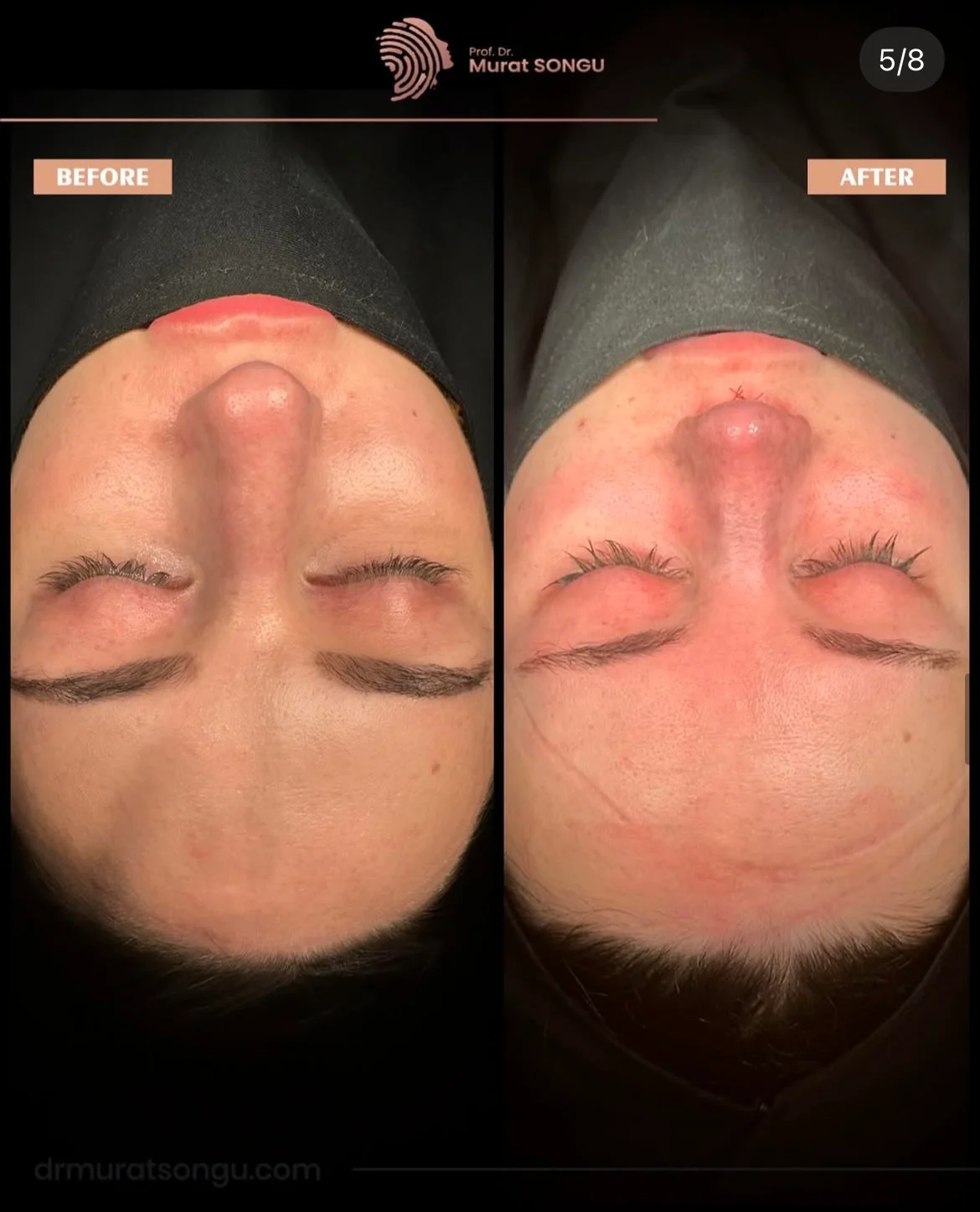 Chirurgie du Nez Dévié Avant & Après