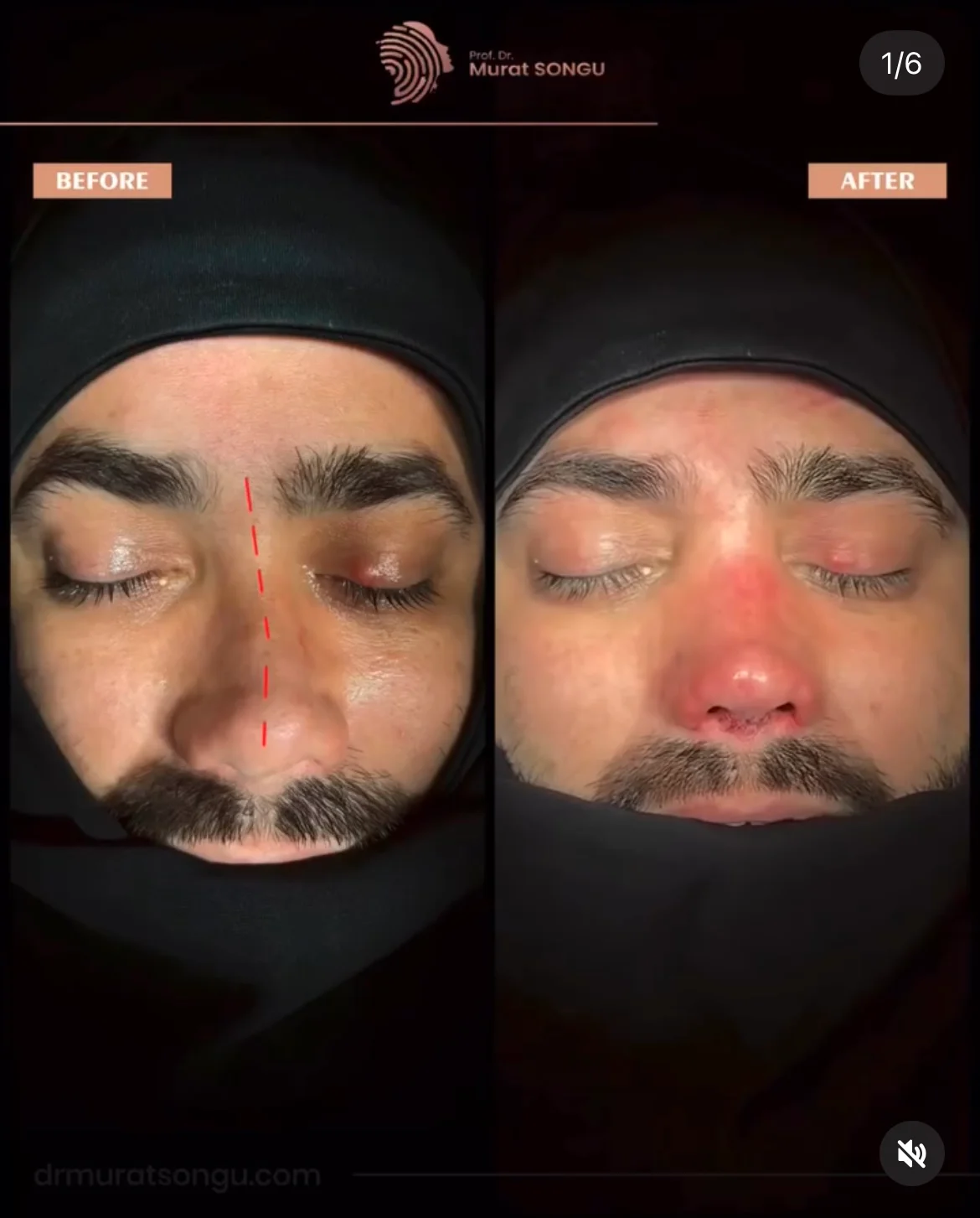 Chirurgie du Nez Dévié Avant & Après