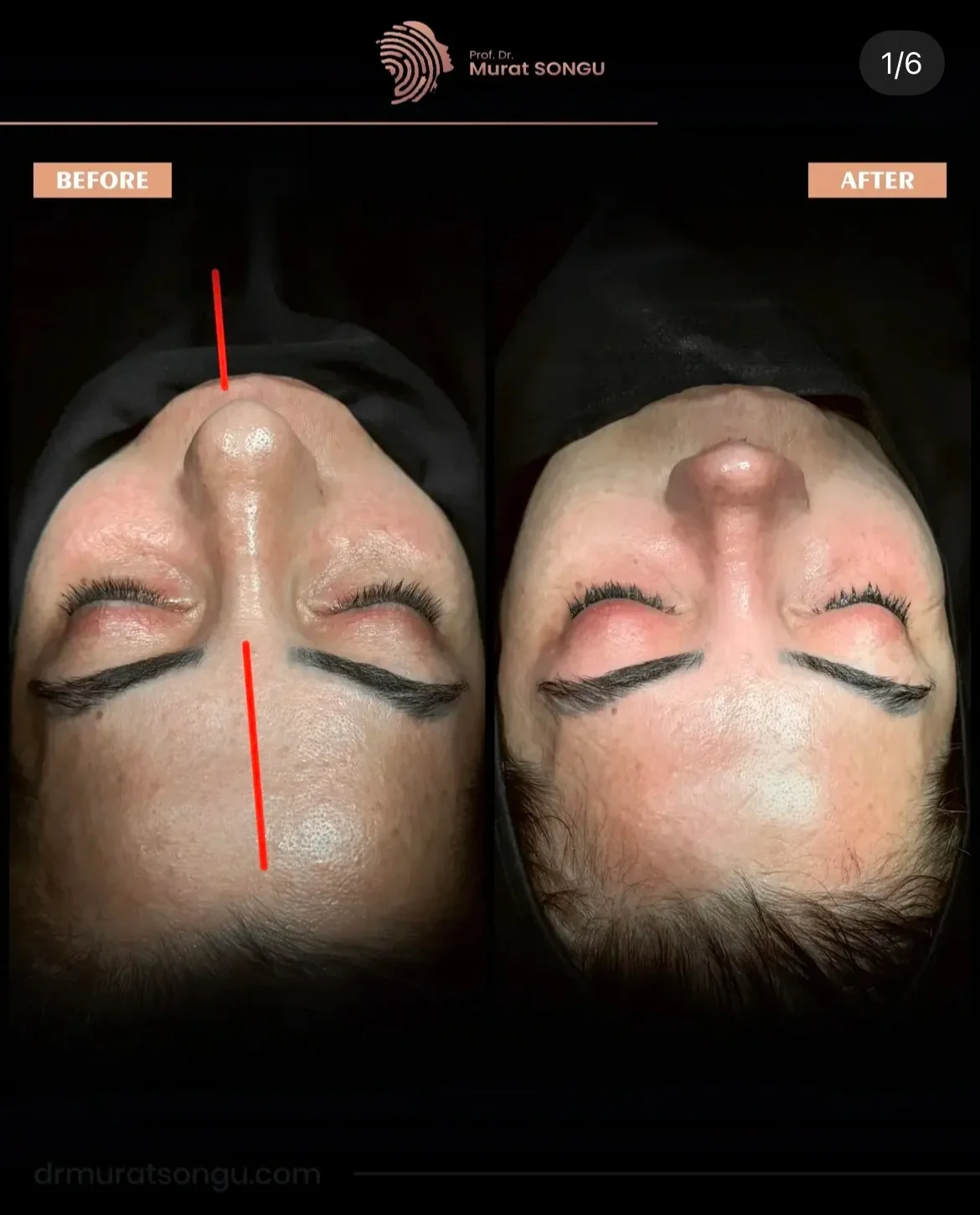 Chirurgie du Nez Dévié Avant & Après