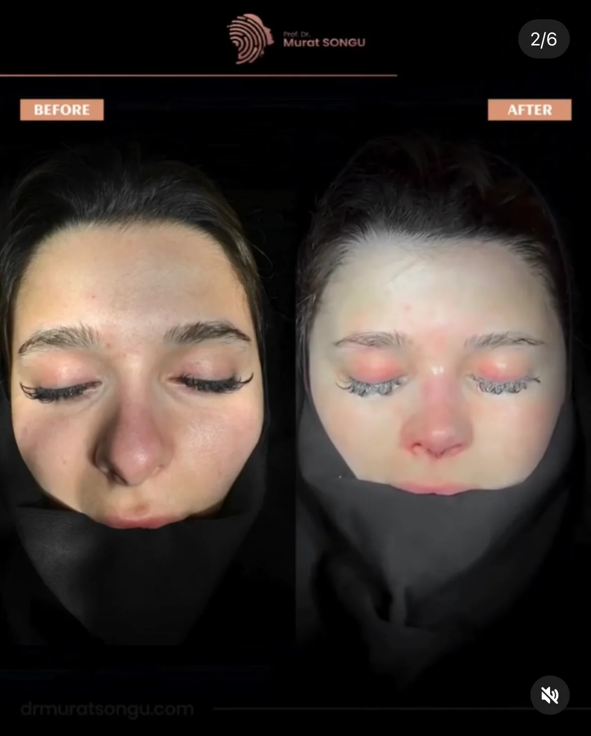 Chirurgie du Nez Dévié Avant & Après