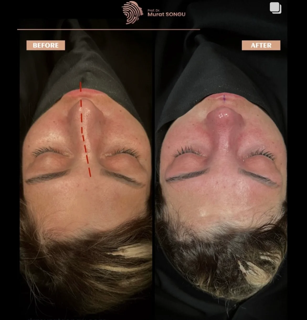 Chirurgie du Nez Dévié Avant & Après