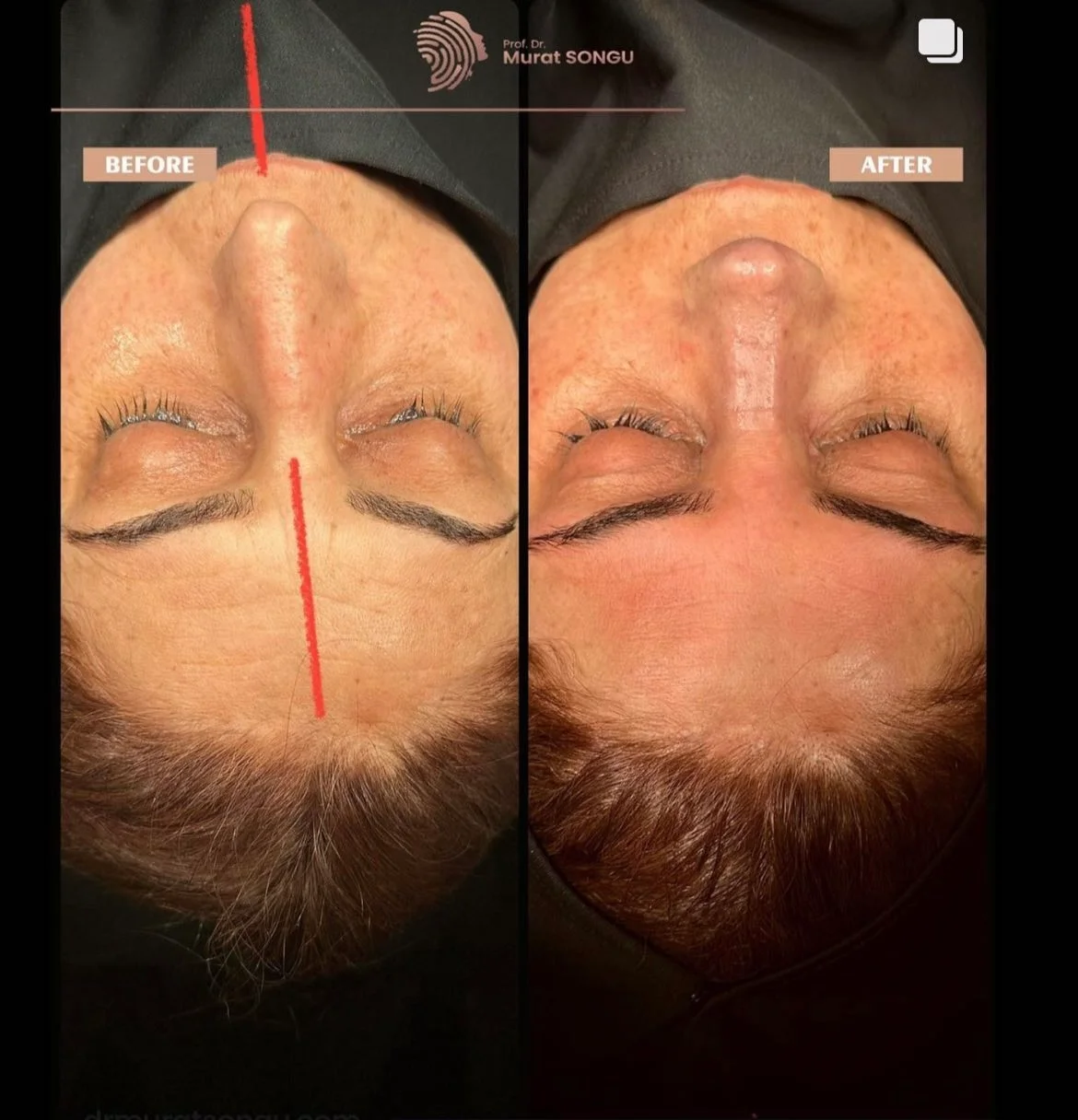 Chirurgie du Nez Dévié Avant & Après