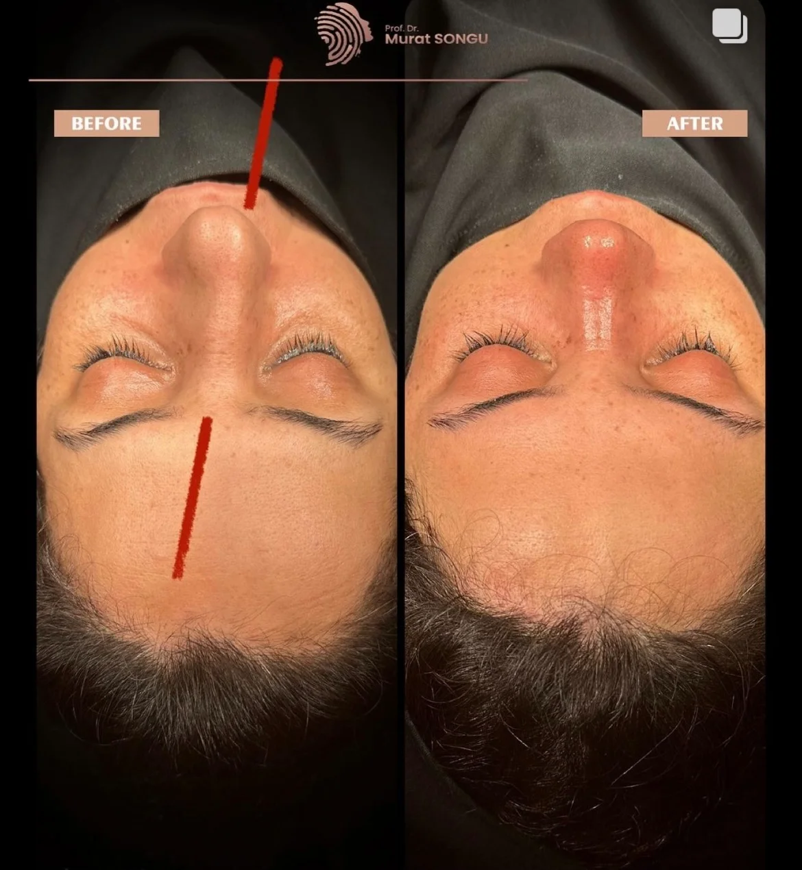 Chirurgie du Nez Dévié Avant & Après