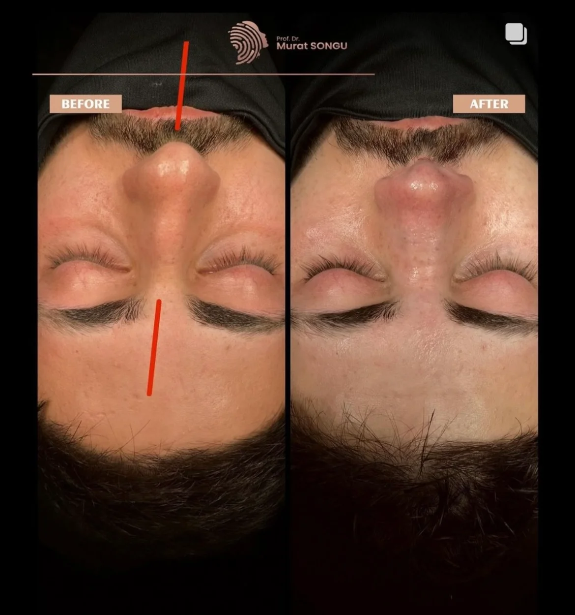 Chirurgie du Nez Dévié Avant & Après