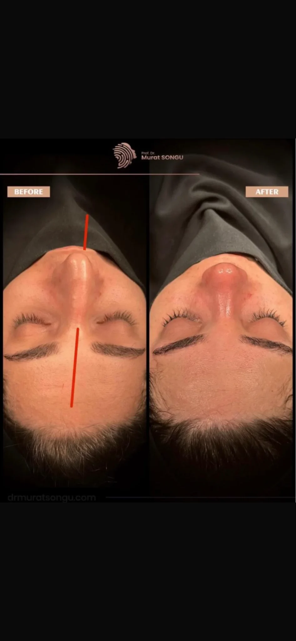 Chirurgie du Nez Dévié Avant & Après