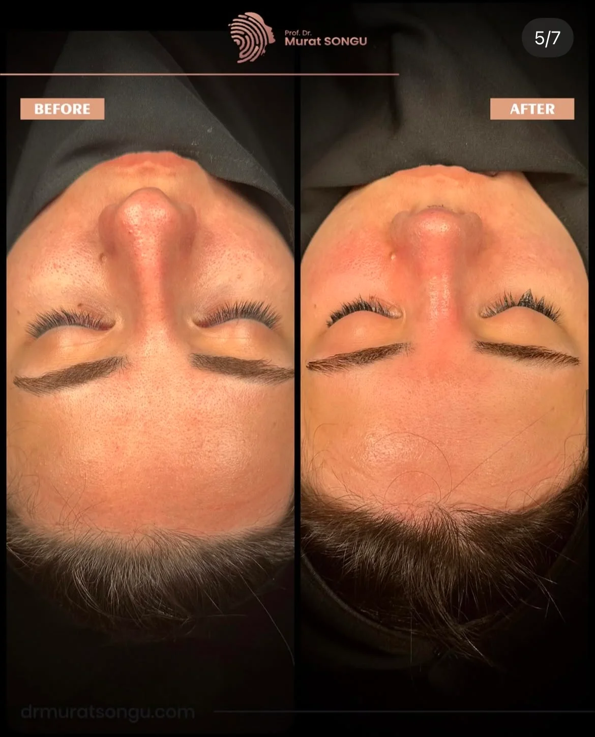 Chirurgie du Nez Dévié Avant & Après