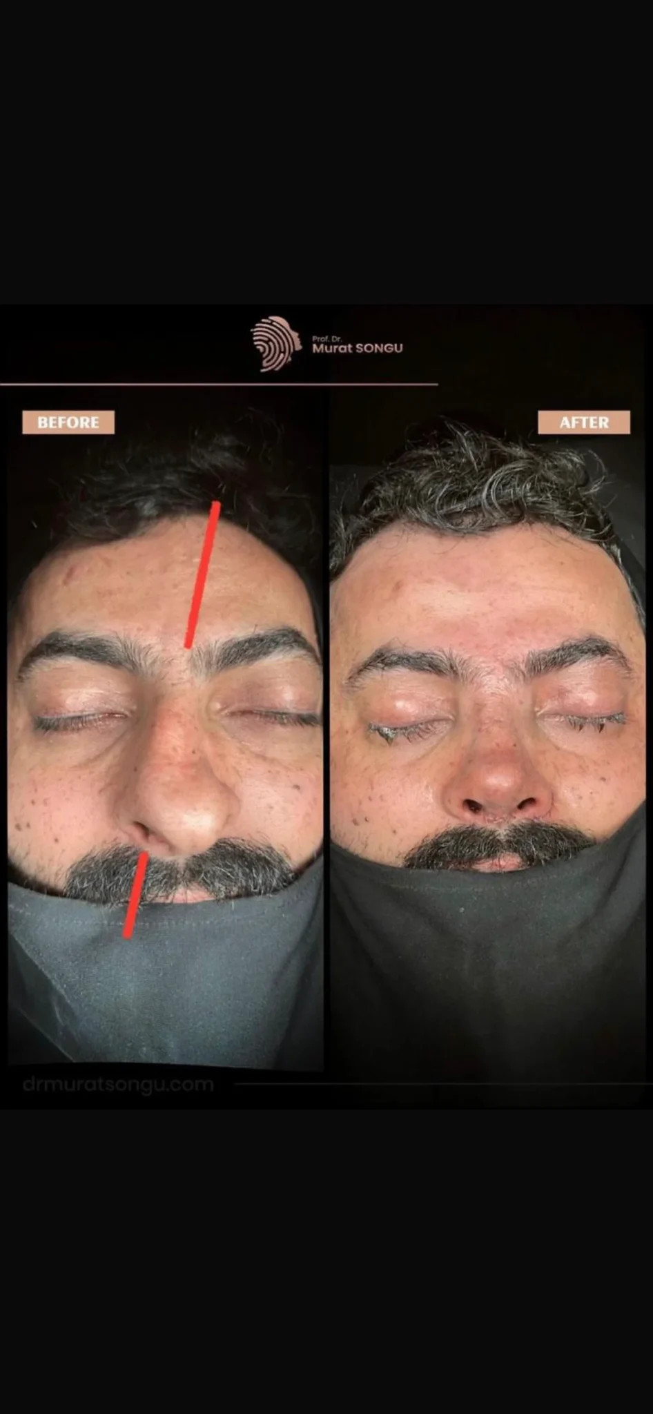 Chirurgie du Nez Dévié Avant & Après