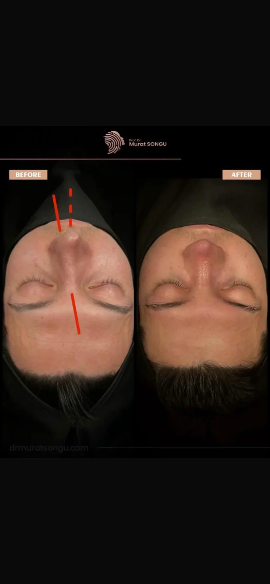 Chirurgie du Nez Dévié Avant & Après