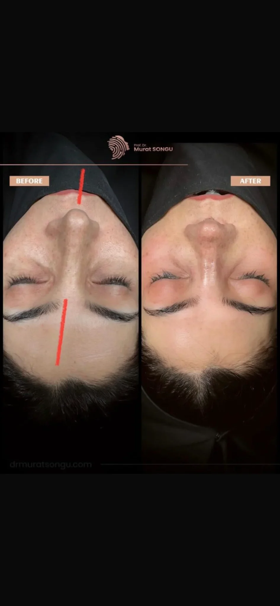 Chirurgie du Nez Dévié Avant & Après