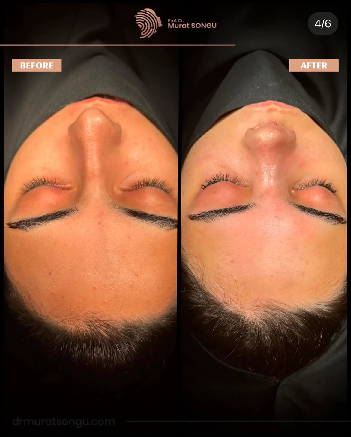 Chirurgie du Nez Dévié Avant & Après