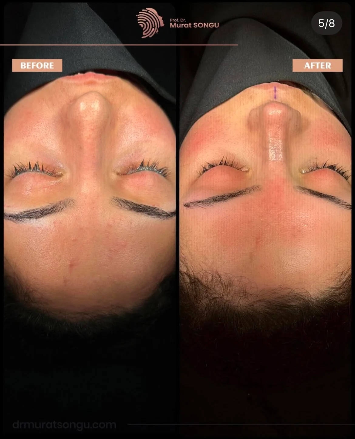 Chirurgie du Nez Dévié Avant & Après